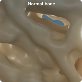 Normal bone