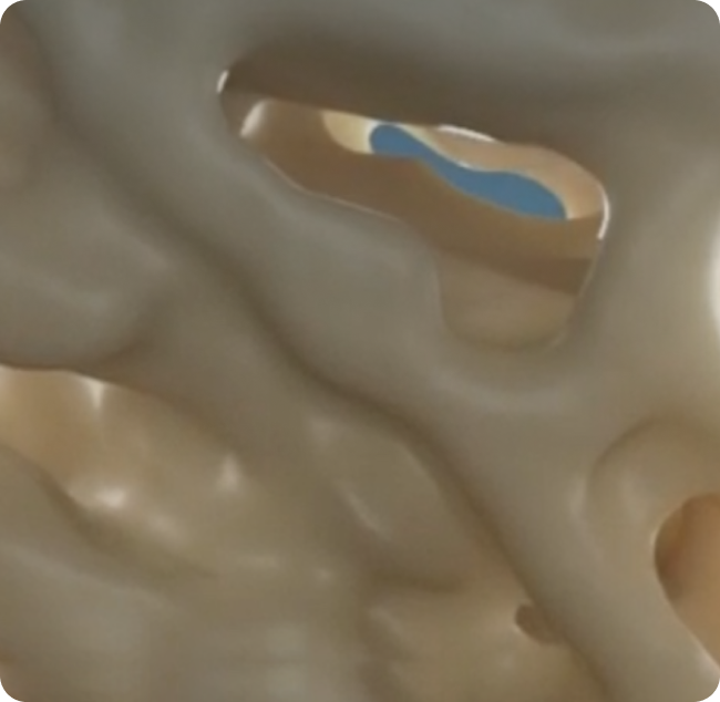 Normal bone compared to bone with osteoporosis