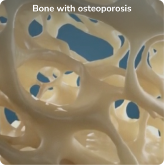 Bone with osteoporosis