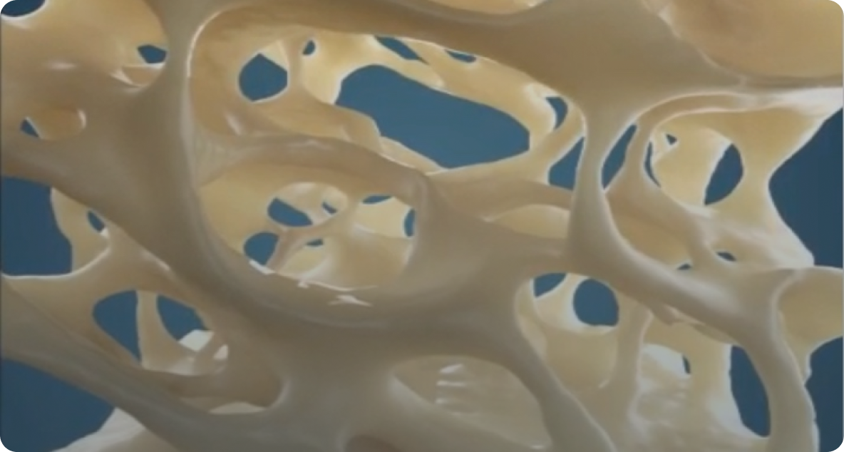 Hueso normal comparado con hueso con osteoporosis