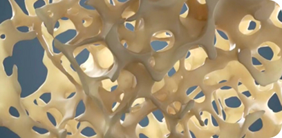 what-is-Postmenopausal-Osteoporosis