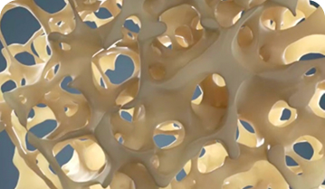 what-is-Postmenopausal-Osteoporosis-mb